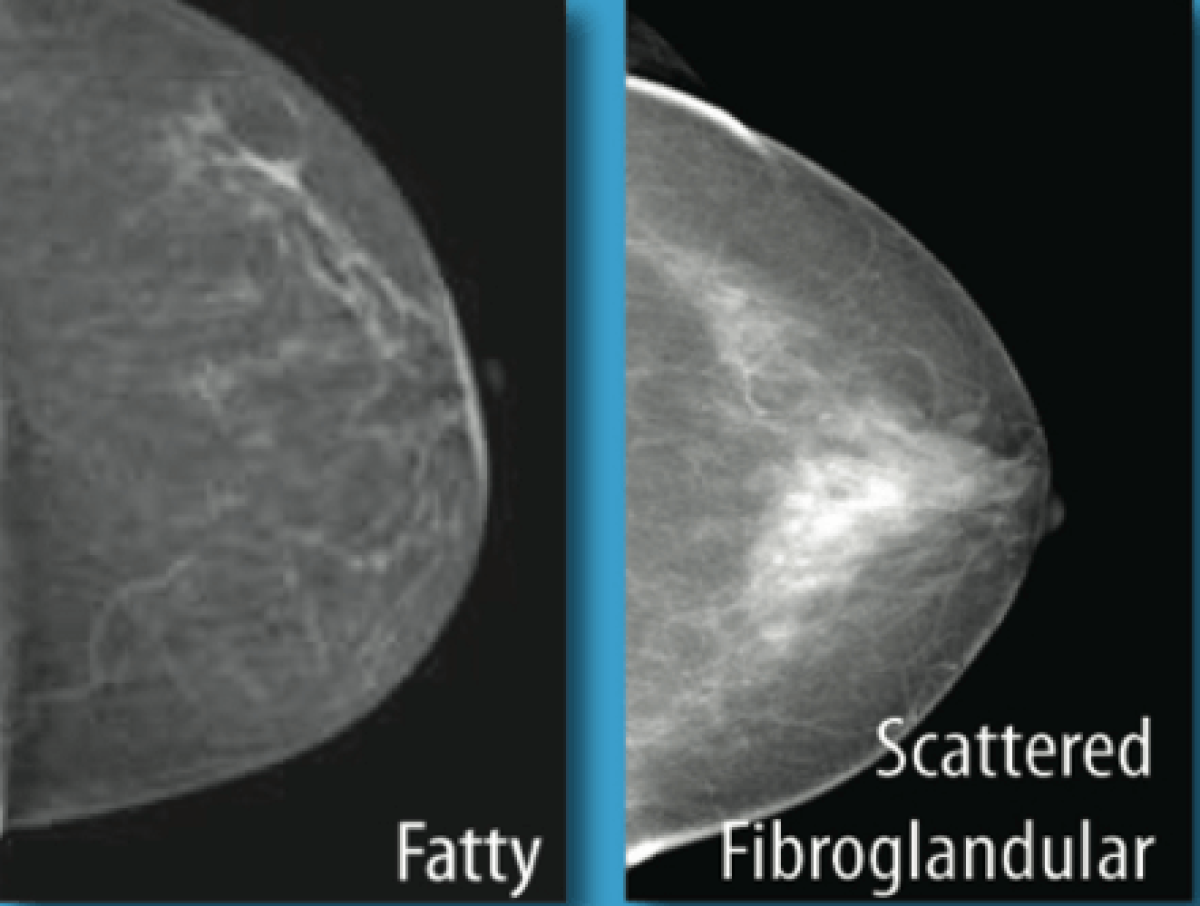 Fibroglandular Density (Dense Breast Tissue): What It Means